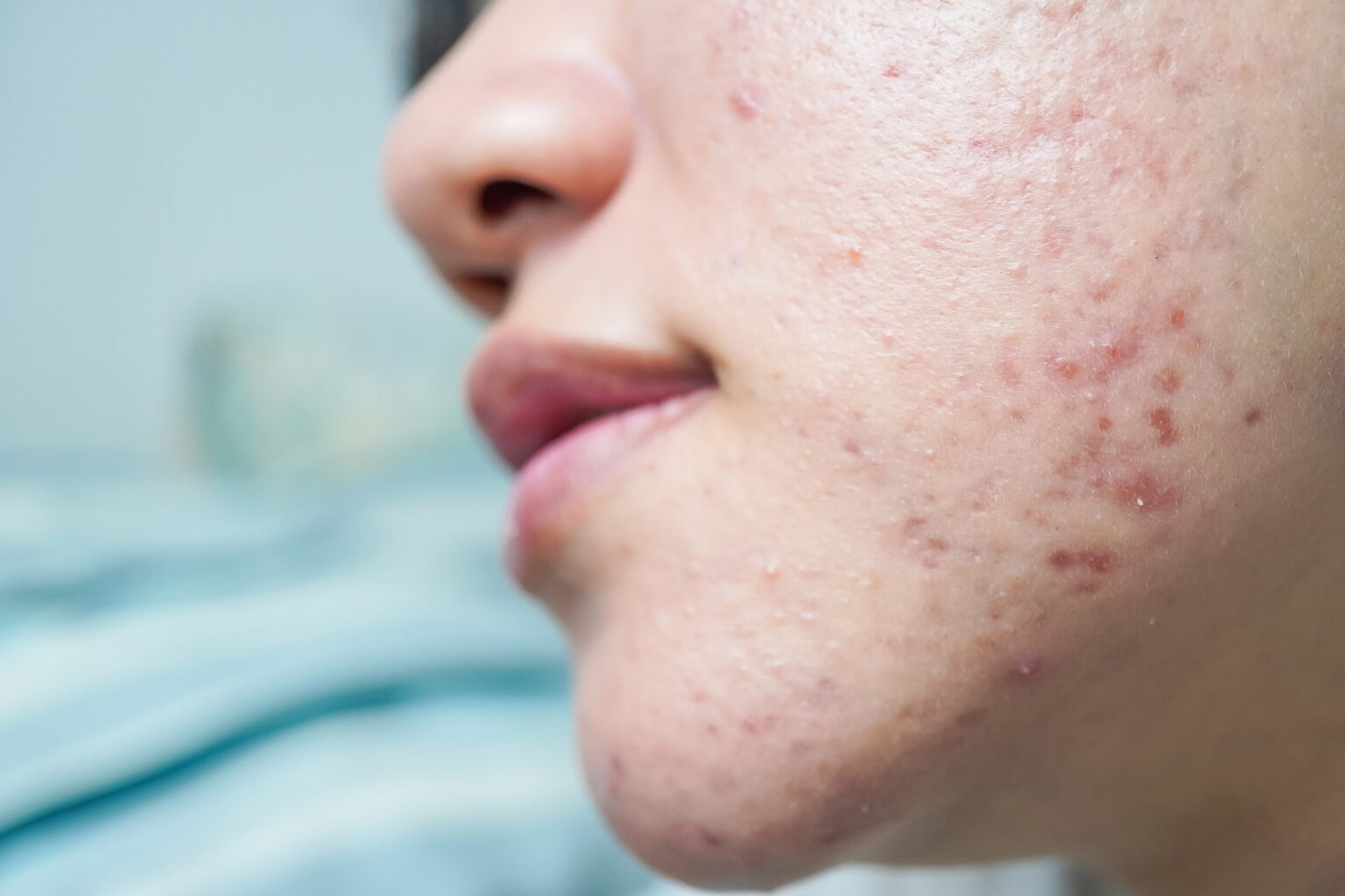cystic acne
