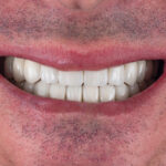 Hollywood Smile