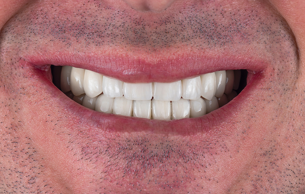 Hollywood Smile