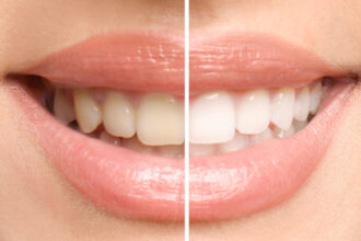 Veneers