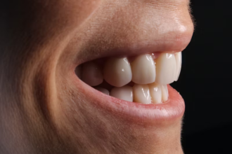 glasgow smile
