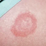 borreliose ausschlag