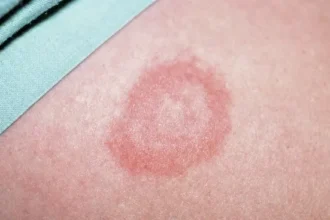 borreliose ausschlag