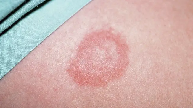 borreliose ausschlag