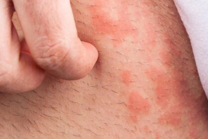 grasmilben ausschlag