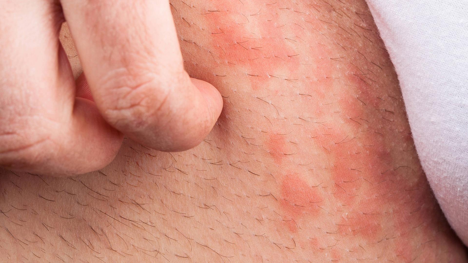 grasmilben ausschlag