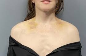 narrow clavicles
