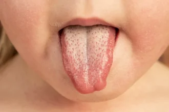 scharlach-ausschlag bilder