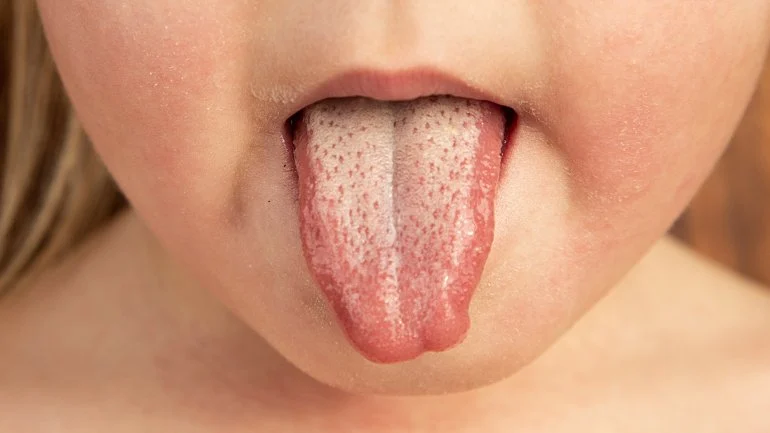 scharlach-ausschlag bilder