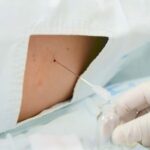 welche krankheit kann man mit lumbalpunktion finden