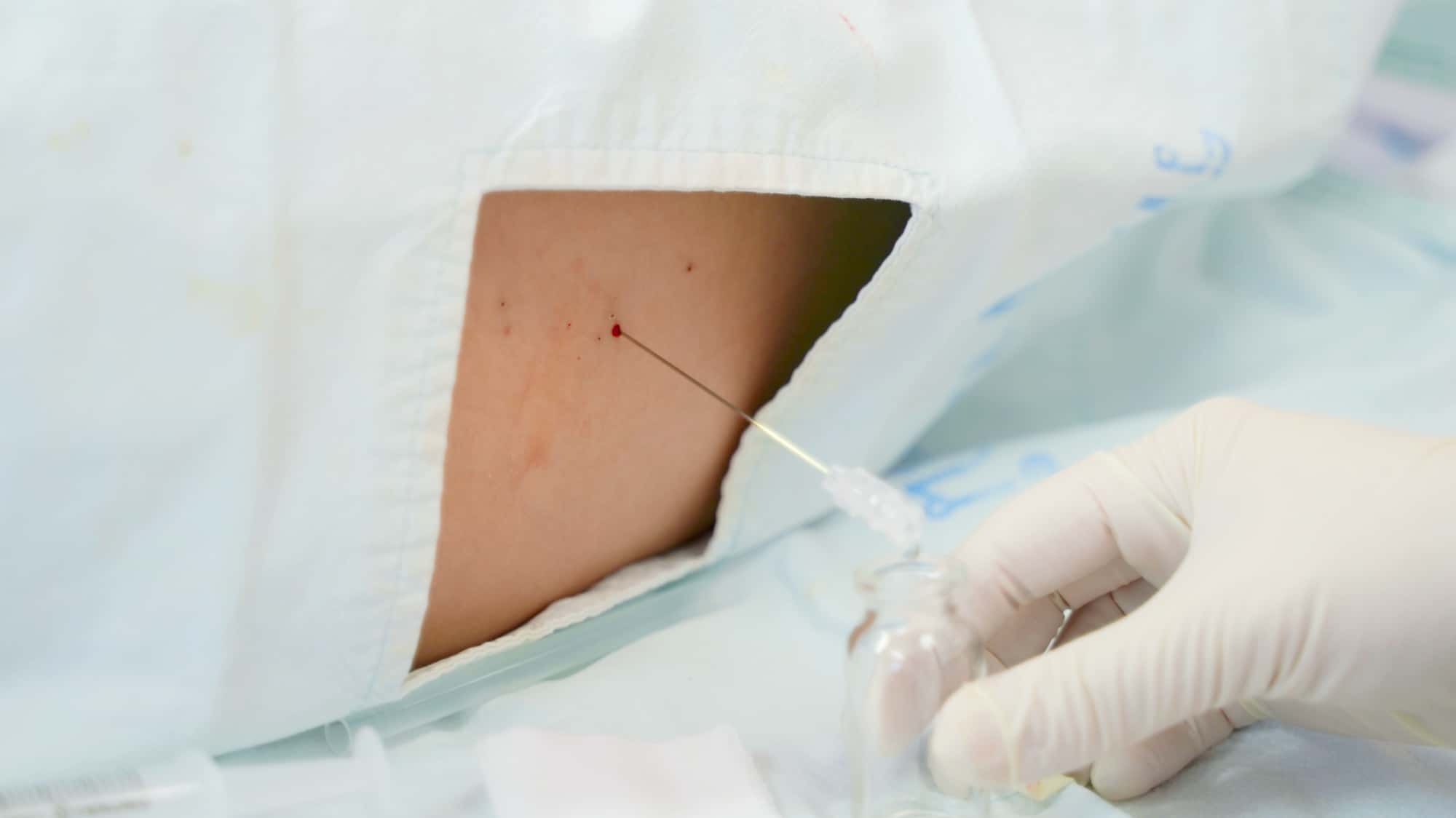 welche krankheit kann man mit lumbalpunktion finden